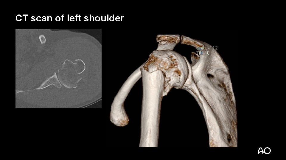 CT scan of left shoulder 