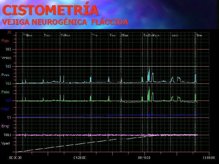 CISTOMETRÍA VEJIGA NEUROGÉNICA FLÁCCIDA 