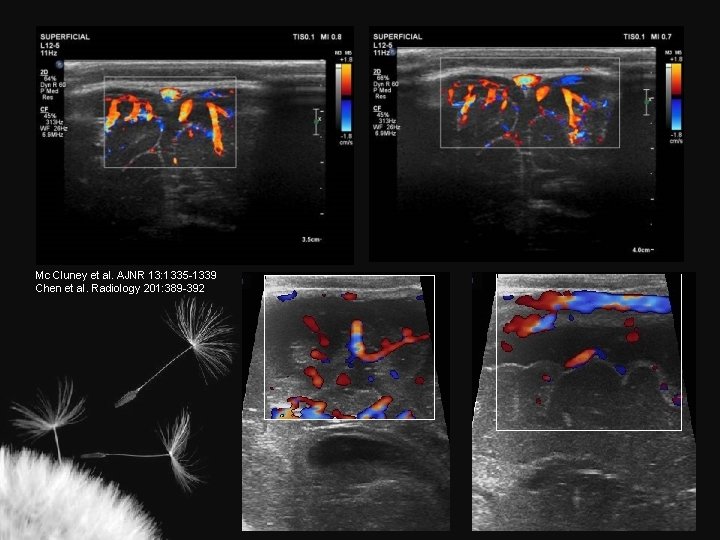 Mc Cluney et al. AJNR 13: 1335 -1339 Chen et al. Radiology 201: 389