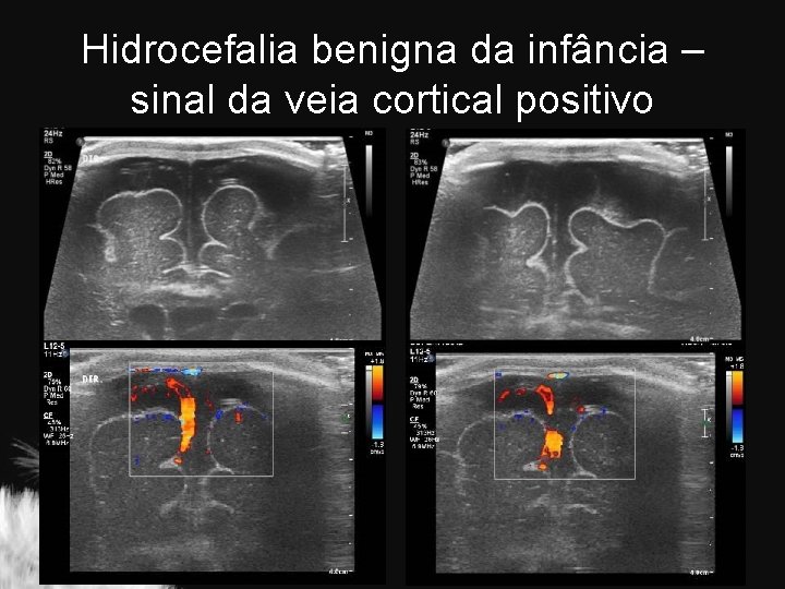 Hidrocefalia benigna da infância – sinal da veia cortical positivo 