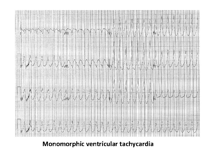 Monomorphic ventricular tachycardia 