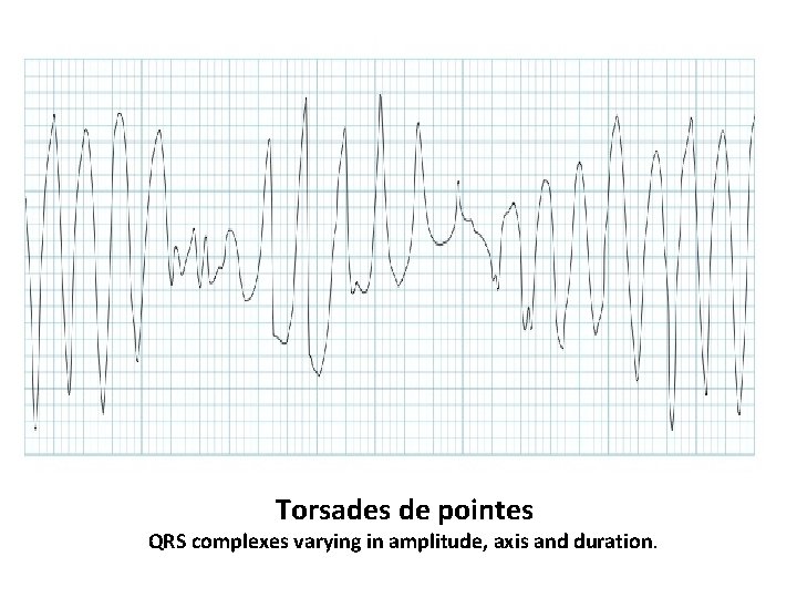 Torsades de pointes QRS complexes varying in amplitude, axis and duration. 