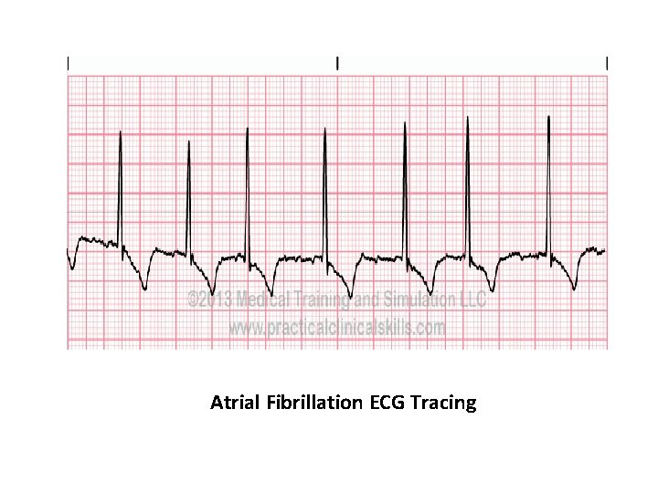 Atrial Fibrillation ECG Tracing 