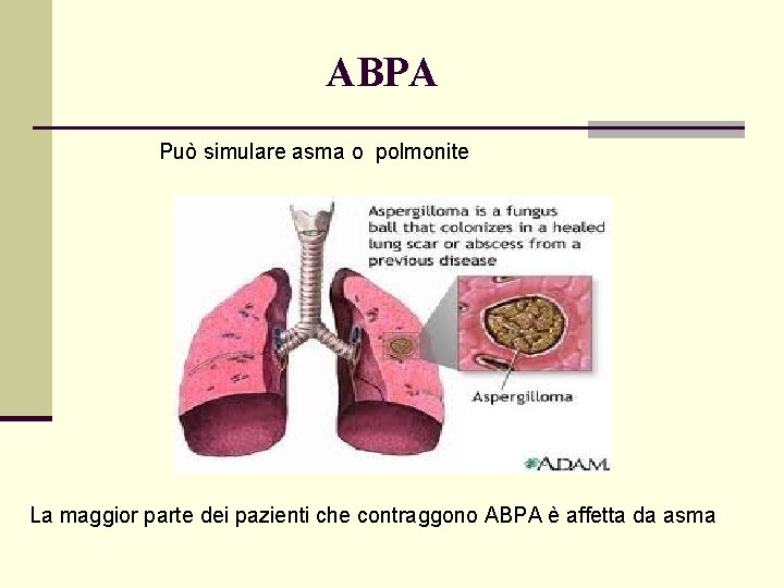 ABPA Può simulare asma o polmonite La maggior parte dei pazienti che contraggono ABPA