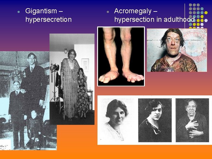 ● Gigantism – hypersecretion ● Acromegaly – hypersection in adulthood 
