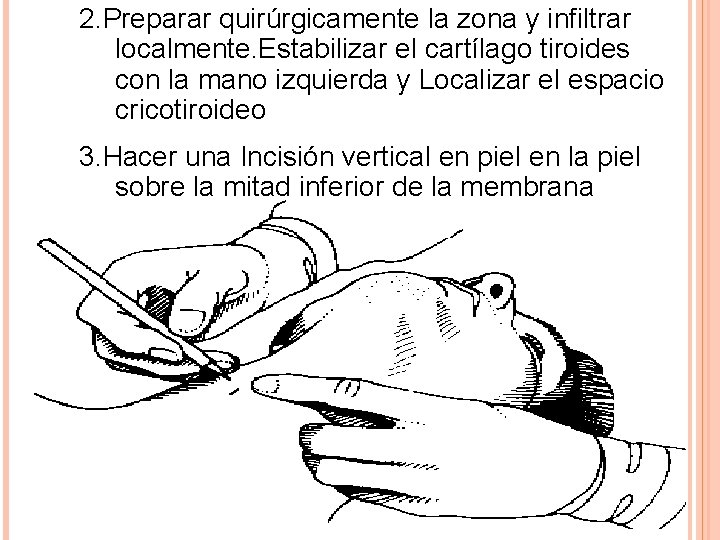 2. Preparar quirúrgicamente la zona y infiltrar localmente. Estabilizar el cartílago tiroides con la 2. Preparar quirúrgicamente la zona y infiltrar localmente. Estabilizar el cartílago tiroides con la