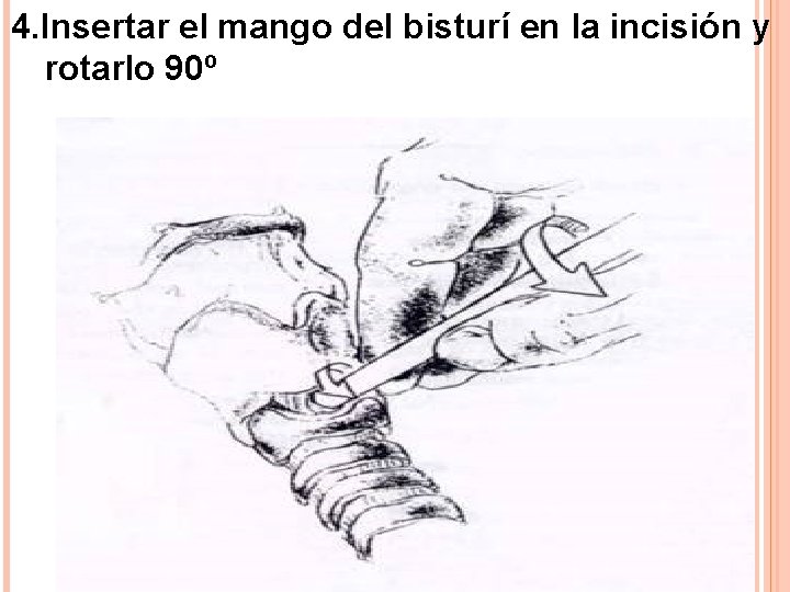 4. Insertar el mango del bisturí en la incisión y rotarlo 90º 4. Insertar el mango del bisturí en la incisión y rotarlo 90º