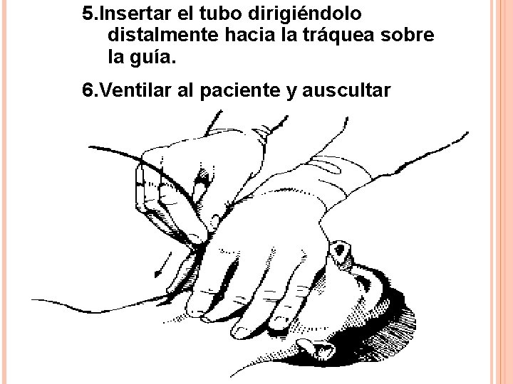 5. Insertar el tubo dirigiéndolo distalmente hacia la tráquea sobre la guía. 6. Ventilar 5. Insertar el tubo dirigiéndolo distalmente hacia la tráquea sobre la guía. 6. Ventilar
