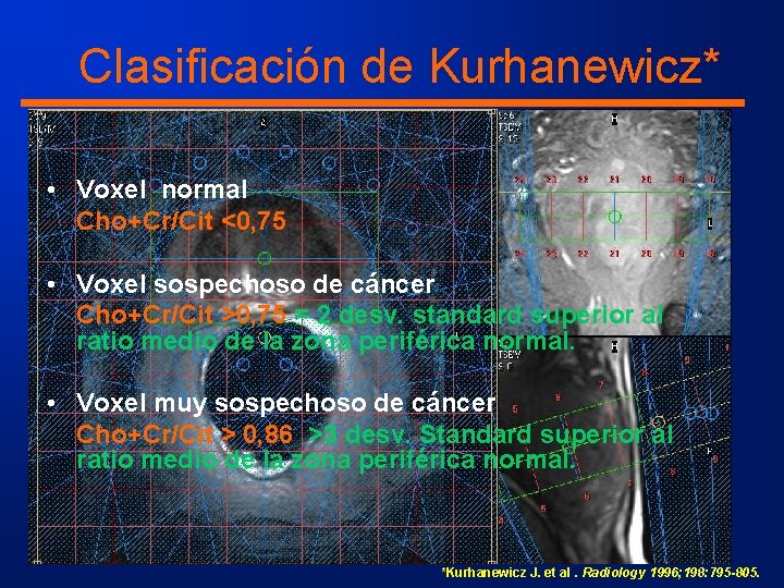 Clasificación de Kurhanewicz* • Voxel normal Cho+Cr/Cit <0, 75 • Voxel sospechoso de cáncer