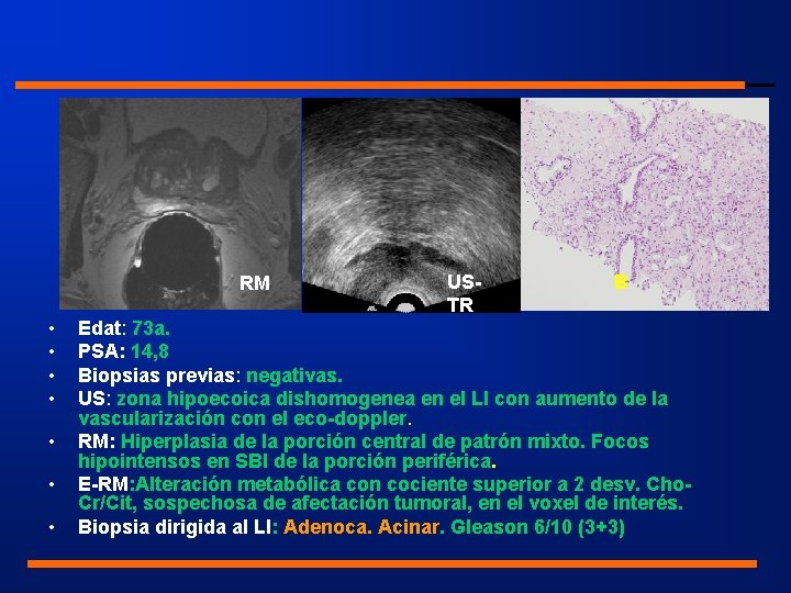 RM • • USTR B Edat: 73 a. PSA: 14, 8 Biopsias previas: negativas.