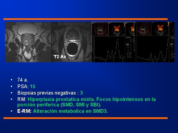 T 2 Cor • • T 2 Ax 74 a. PSA: 15 Biopsias previas