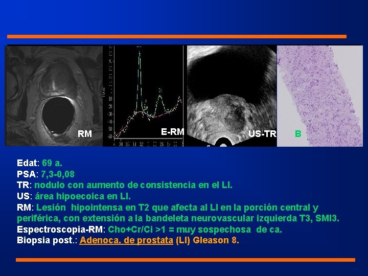 RM E-RM US-TR B Edat: 69 a. PSA: 7, 3 -0, 08 TR: nodulo