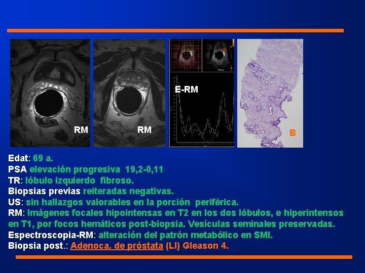 E-RM RM RM B Edat: 69 a. PSA elevación progresiva 19, 2 -0, 11