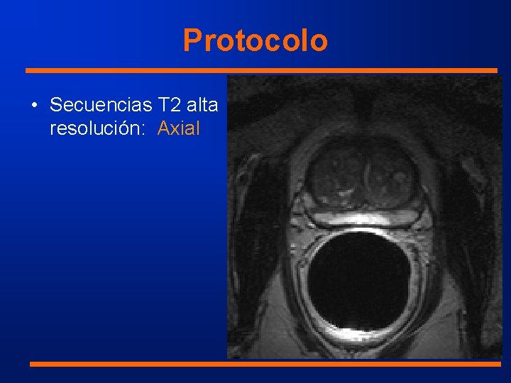 Protocolo • Secuencias T 2 alta resolución: Axial 