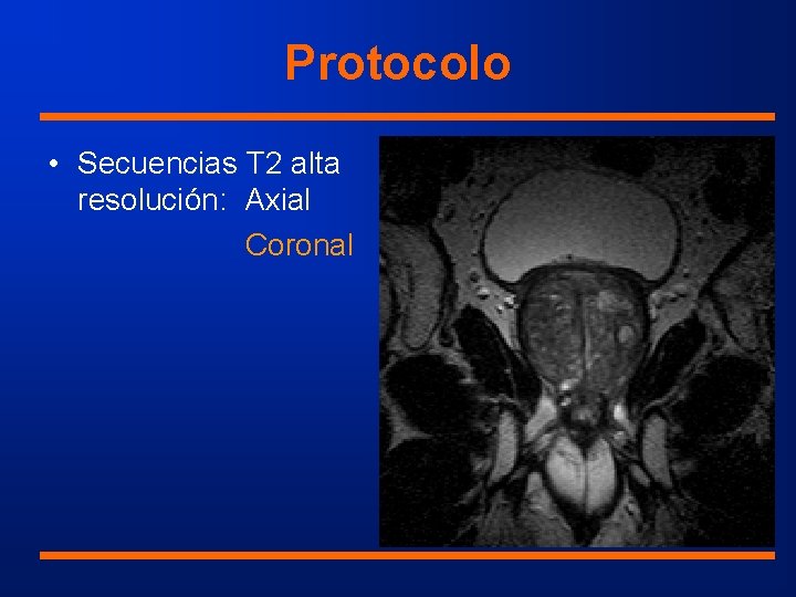 Protocolo • Secuencias T 2 alta resolución: Axial Coronal 