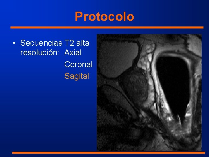 Protocolo • Secuencias T 2 alta resolución: Axial Coronal Sagital 