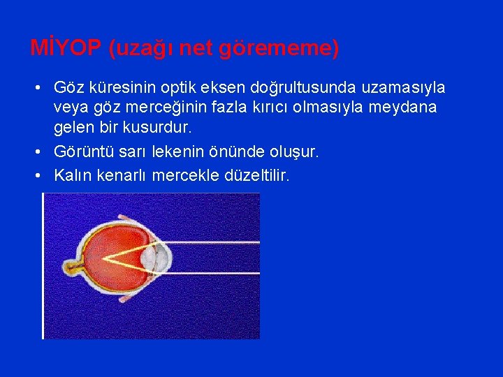 MİYOP (uzağı net görememe) • Göz küresinin optik eksen doğrultusunda uzamasıyla veya göz merceğinin