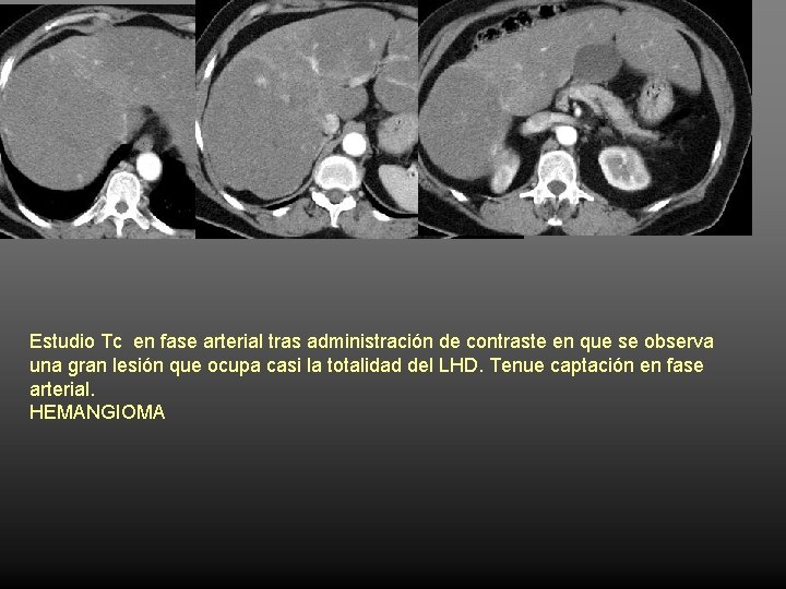 Estudio Tc en fase arterial tras administración de contraste en que se observa una