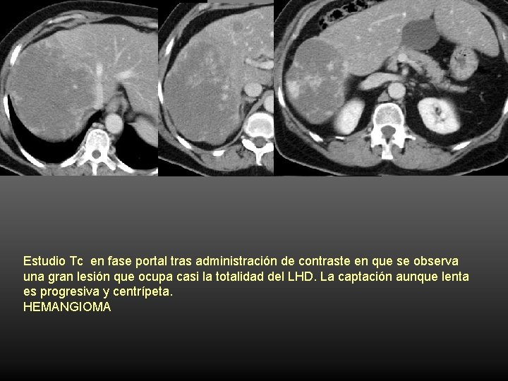 Estudio Tc en fase portal tras administración de contraste en que se observa una