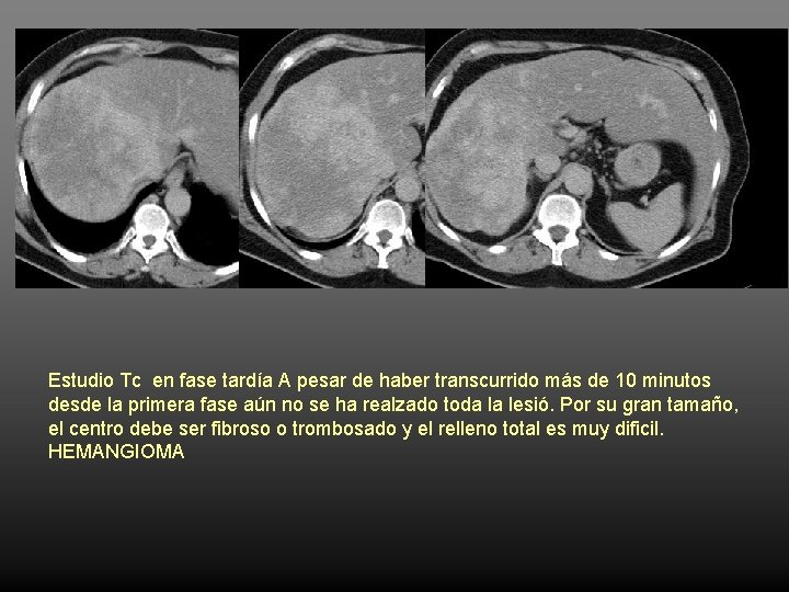 Estudio Tc en fase tardía A pesar de haber transcurrido más de 10 minutos