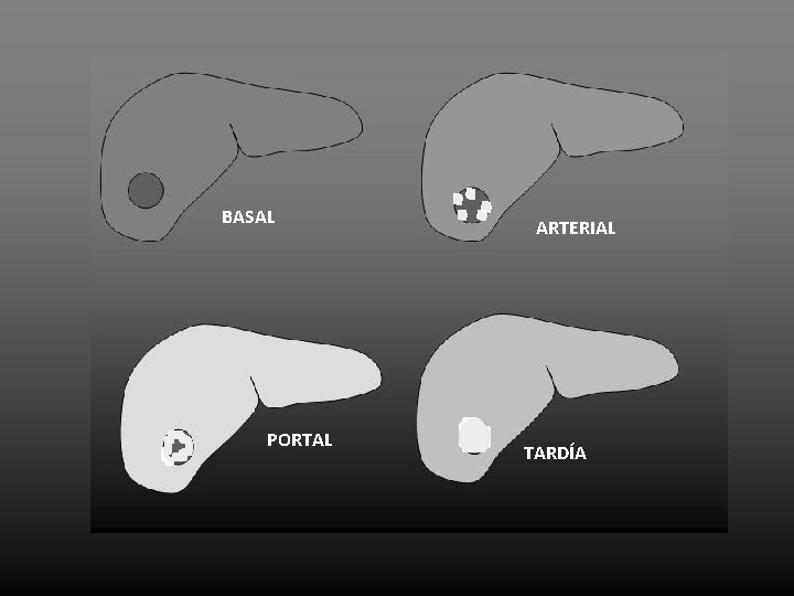 BASAL PORTAL ARTERIAL TARDÍA 