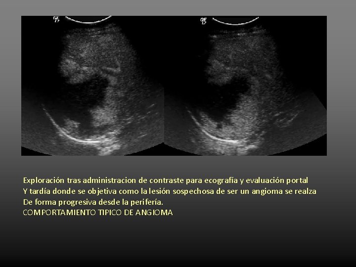 Exploración tras administracion de contraste para ecografía y evaluación portal Y tardía donde se