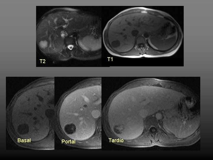 T 2 T 1 El comportamiento RM más típico del hemangioma es marcadamente hiperintenso