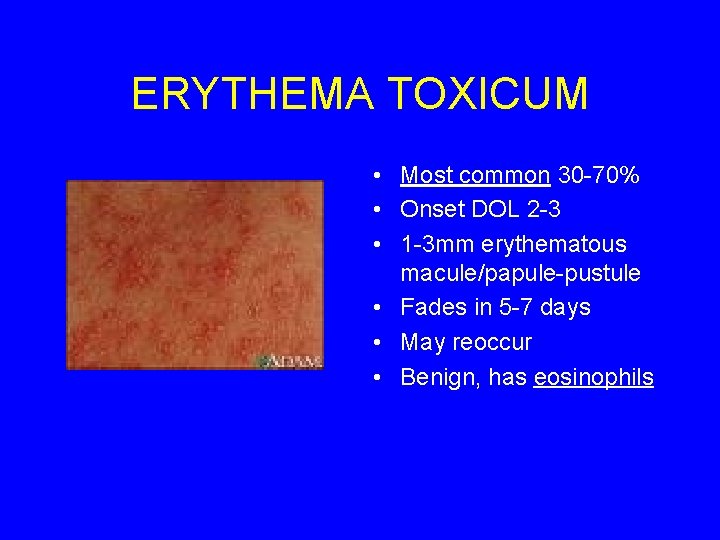 ERYTHEMA TOXICUM • Most common 30 -70% • Onset DOL 2 -3 • 1