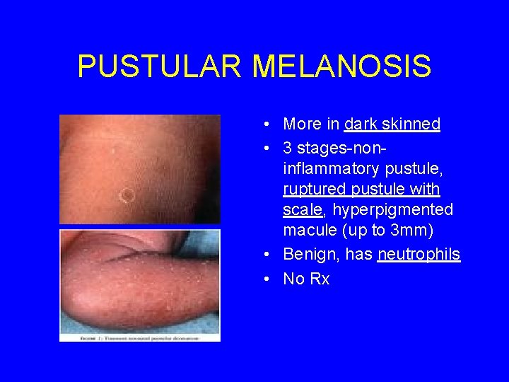 PUSTULAR MELANOSIS • More in dark skinned • 3 stages-noninflammatory pustule, ruptured pustule with