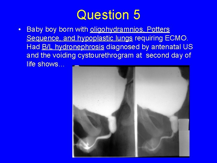 Question 5 • Baby born with oligohydramnios, Potters Sequence, and hypoplastic lungs requiring ECMO.