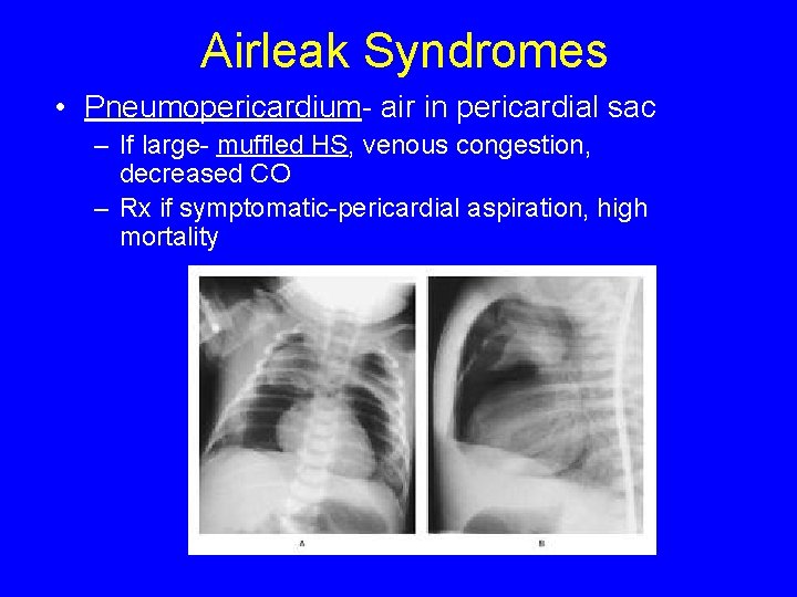 Airleak Syndromes • Pneumopericardium- air in pericardial sac – If large- muffled HS, venous
