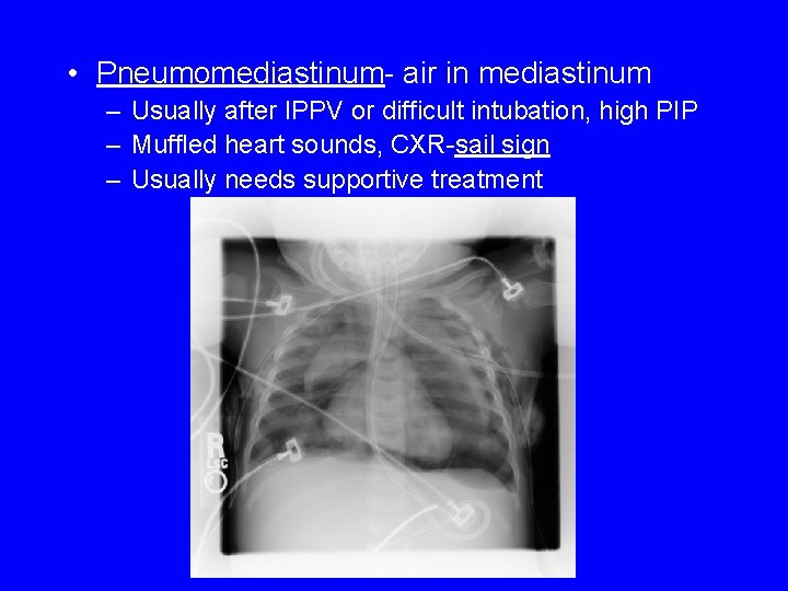  • Pneumomediastinum- air in mediastinum – Usually after IPPV or difficult intubation, high