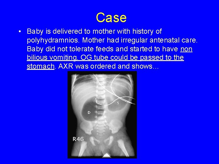 Case • Baby is delivered to mother with history of polyhydramnios. Mother had irregular