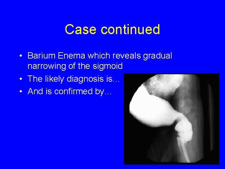 Case continued • Barium Enema which reveals gradual narrowing of the sigmoid • The