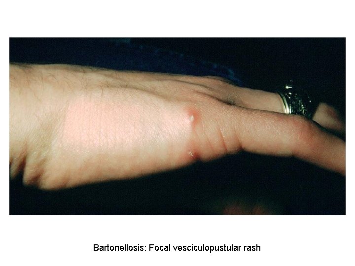 Bartonellosis: Focal vesciculopustular rash 