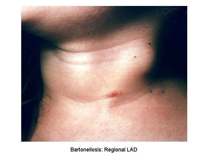 Bartonellosis: Regional LAD 