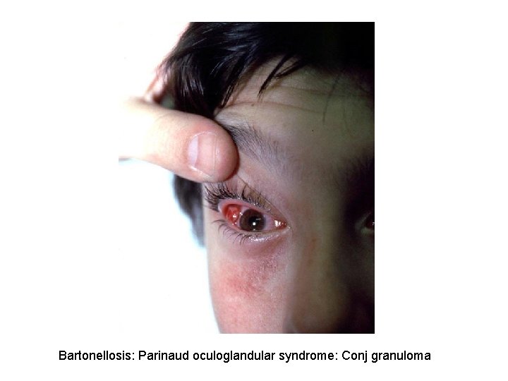 Bartonellosis: Parinaud oculoglandular syndrome: Conj granuloma 