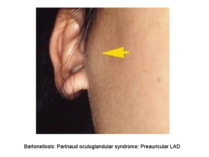 Bartonellosis: Parinaud oculoglandular syndrome: Preauricular LAD 