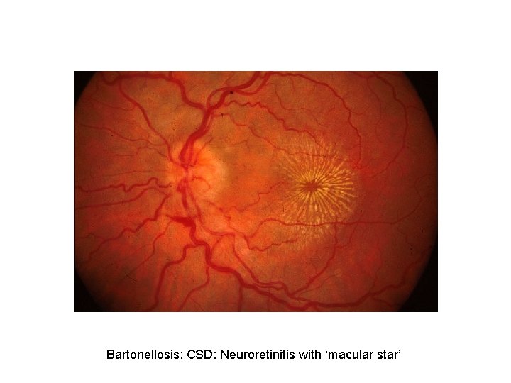 Bartonellosis: CSD: Neuroretinitis with ‘macular star’ 