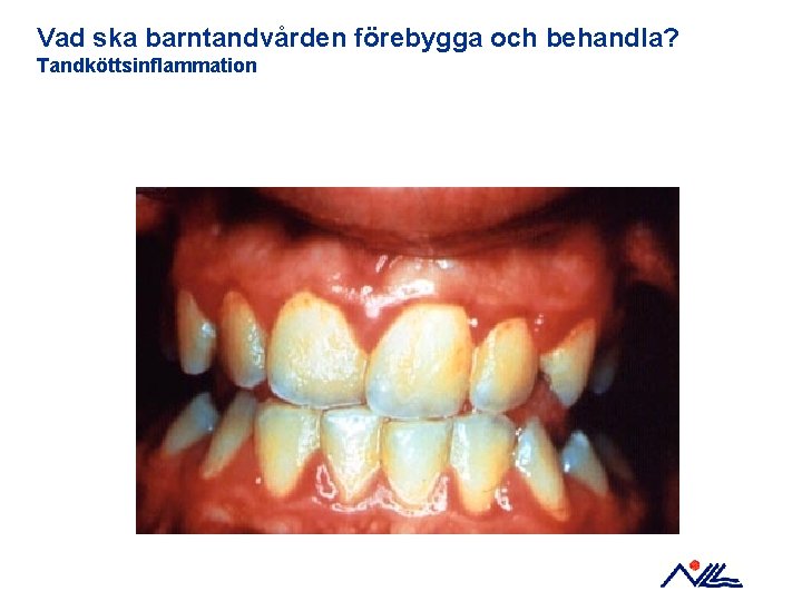 Vad ska barntandvården förebygga och behandla? Tandköttsinflammation 