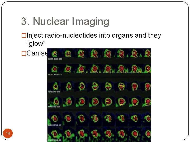 3. Nuclear Imaging �Inject radio-nucleotides into organs and they “glow” �Can see function 14 3. Nuclear Imaging �Inject radio-nucleotides into organs and they “glow” �Can see function 14