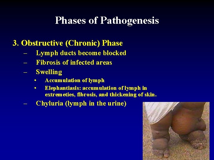 Phases of Pathogenesis 3. Obstructive (Chronic) Phase – – – Lymph ducts become blocked