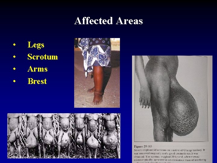Affected Areas • • Legs Scrotum Arms Brest 