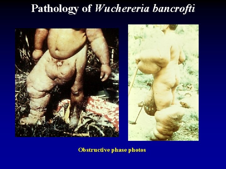 Pathology of Wuchereria bancrofti Obstructive phase photos 