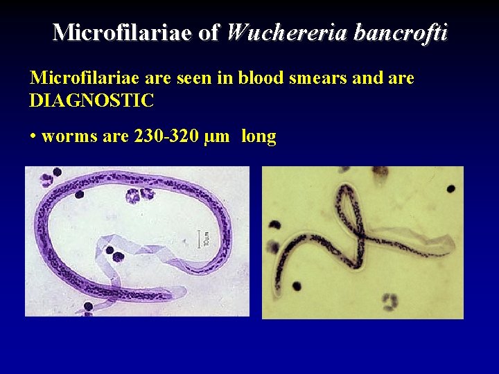 Microfilariae of Wuchereria bancrofti Microfilariae are seen in blood smears and are DIAGNOSTIC •