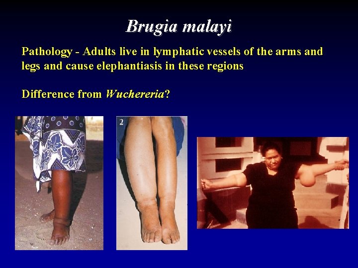 Brugia malayi Pathology - Adults live in lymphatic vessels of the arms and legs