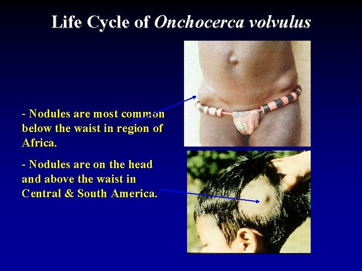 Life Cycle of Onchocerca volvulus - Nodules are most common below the waist in