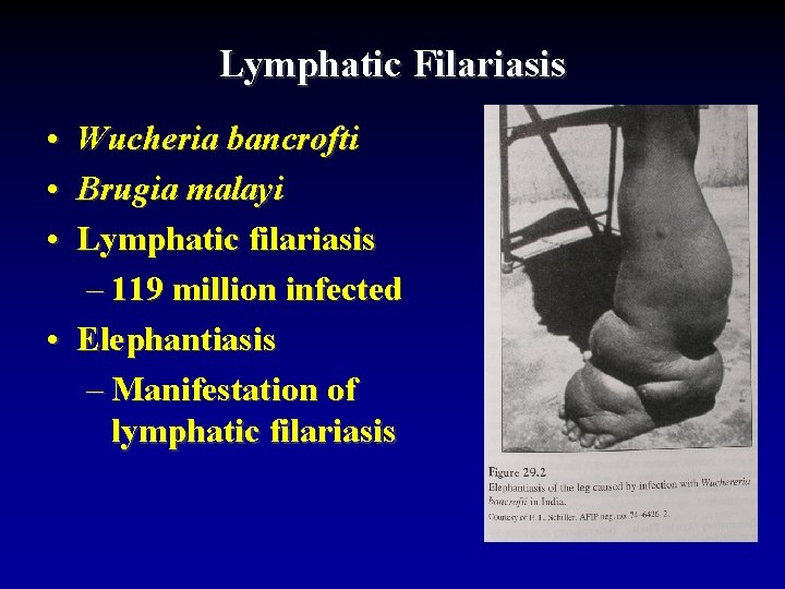 Lymphatic Filariasis • Wucheria bancrofti • Brugia malayi • Lymphatic filariasis – 119 million