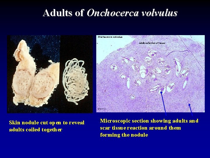 Adults of Onchocerca volvulus Skin nodule cut open to reveal adults coiled together Microscopic
