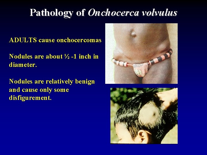 Pathology of Onchocerca volvulus ADULTS cause onchocercomas Nodules are about ½ -1 inch in